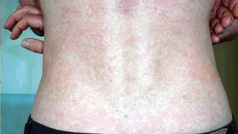 Chikungunya
