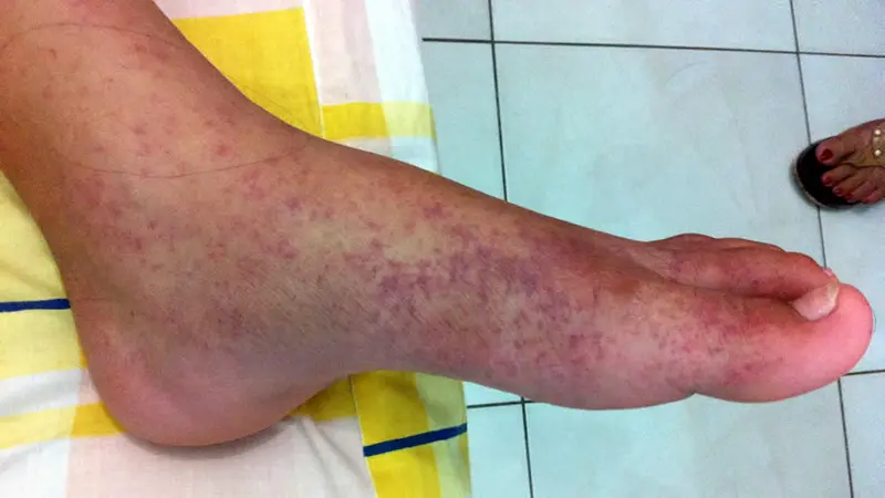 Chikungunya