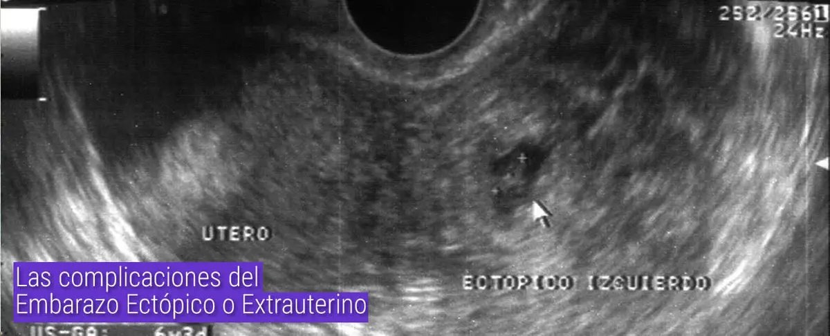 Las complicaciones del Embarazo Ectópico o Extrauterino