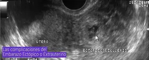 Las complicaciones del Embarazo Ectópico o Extrauterino
