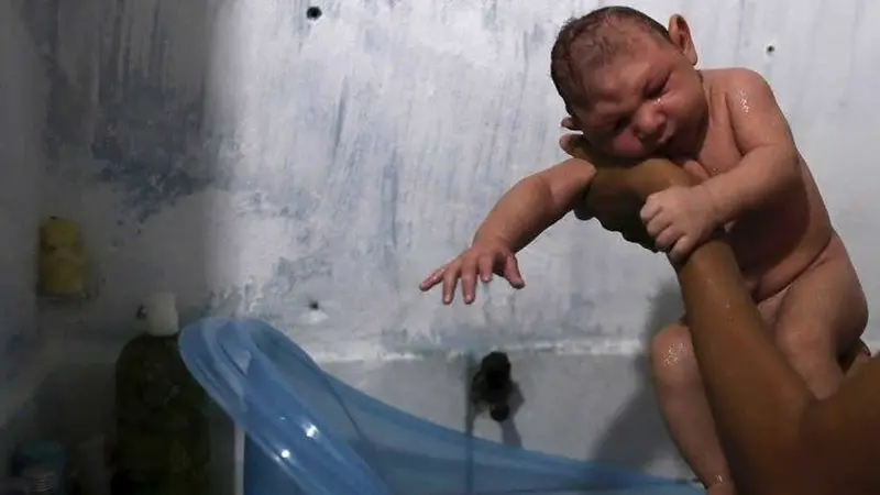 Brasil confirmó más de 500 casos de microcefalia relacionados al zika