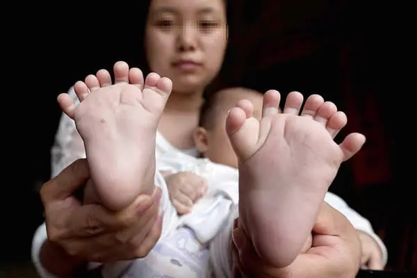 Niño chino nació con 31 dedos y sus padres ruegan por una operación