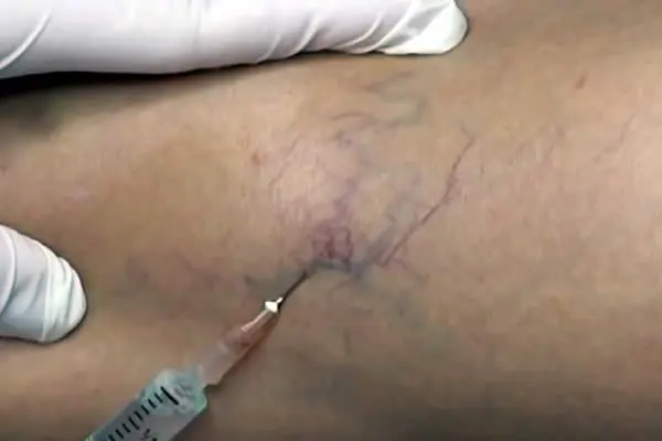 Las Varices: Dilataciones venosas con rostro de mujer