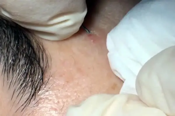 ¿Por qué tengo tanto acné en el rostro?