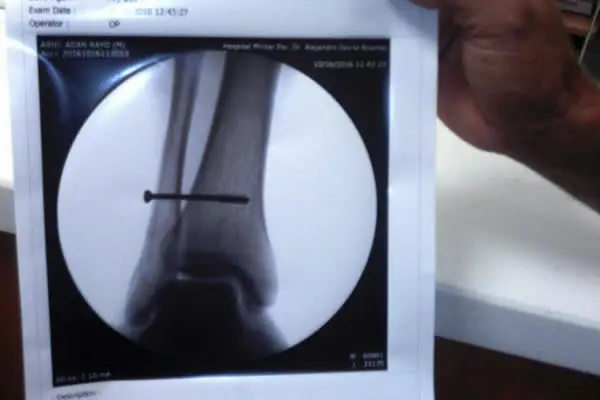 Ariel Rayo de los indígenas de matagalpa fue operado con éxito en el hospital militar