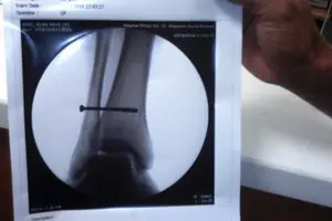 Ariel Rayo de los indígenas de matagalpa fue operado con éxito en el hospital militar
