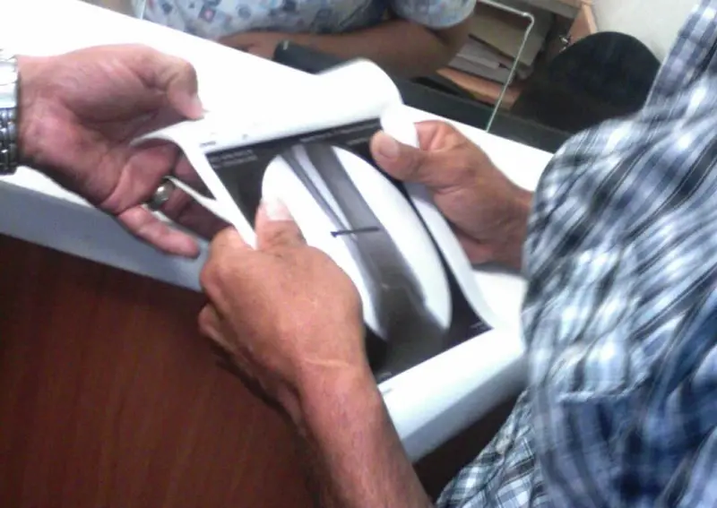 Ariel Rayo de los indígenas de matagalpa fue operado con éxito en el hospital militar