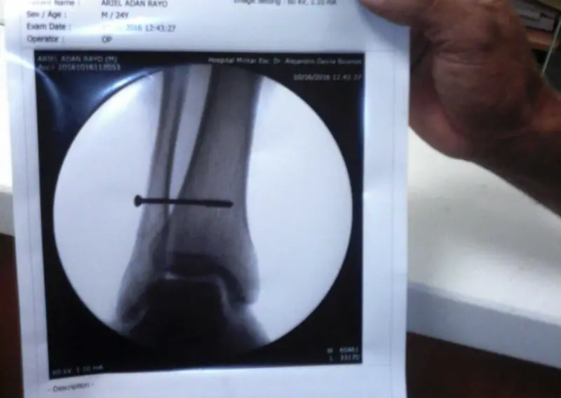 Ariel Rayo de los indígenas de matagalpa fue operado con éxito en el hospital militar