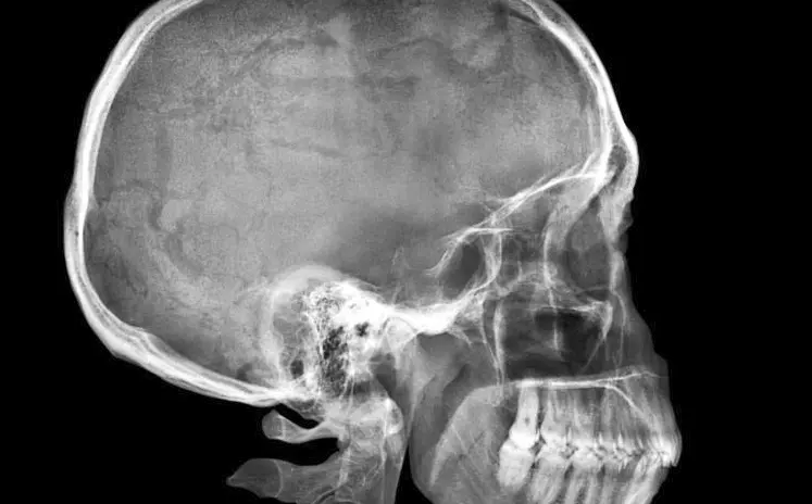 Mujer paso por dos meses con bala incrustada en cráneo darse cuenta