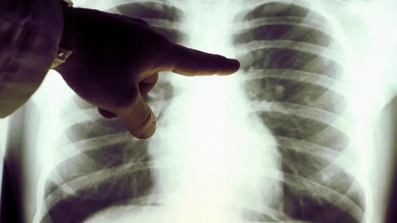 Un nuevo método para vigilar mi cuerpo de posibles tumores con GPS
