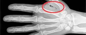 Un nuevo método para vigilar el cuerpo humano con GPS de posibles tumores