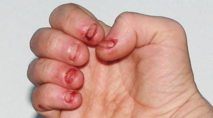 ¿ Sabías que comerse las uñas genera cáncer? 
