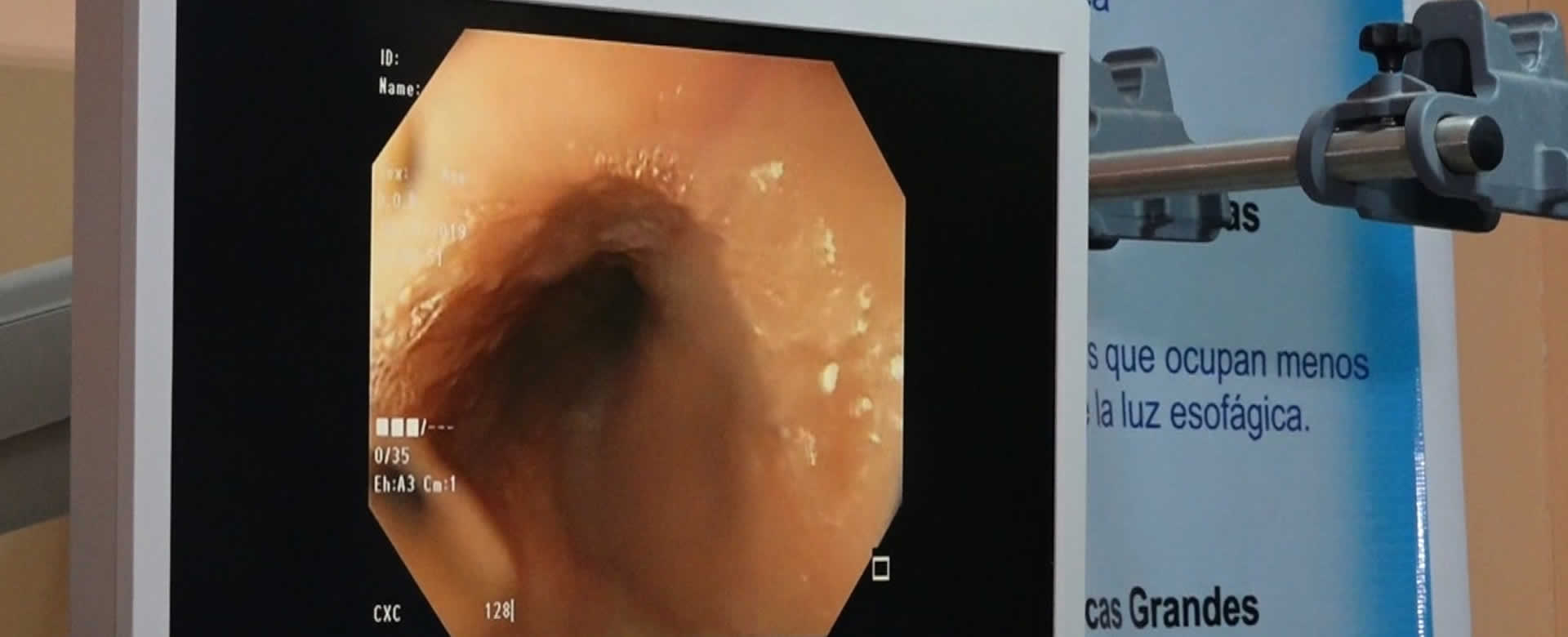 Pacientes de gastroscospia reciben atención en jornada de endoscopia