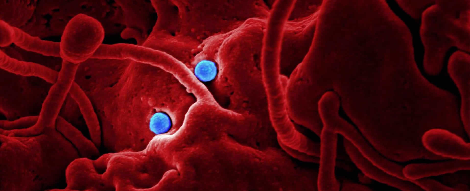 Cura del Coronavirus está en Cuba, Interferón Alfa 2-B recombinante
