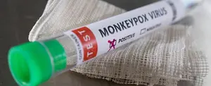 Estados Unidos reporta más de 17 mil casos de la viruela del mono