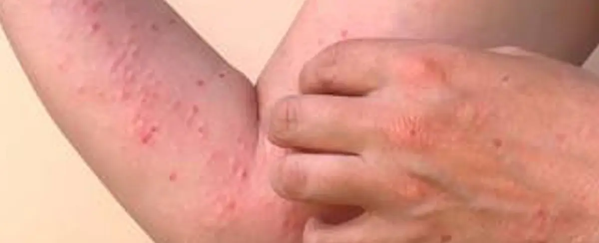 India: gripe del tomate, la nueva infección viral que se propaga en niños