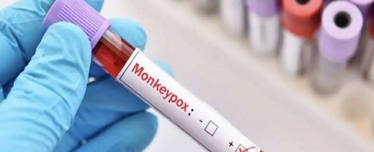 México registra 147 casos de la viruela del mono
