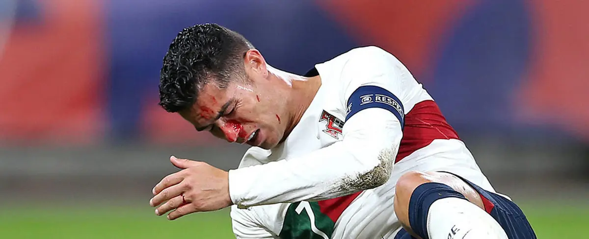 Cristiano Ronaldo sufre un duro golpe en la nariz durante partido contra República Checa