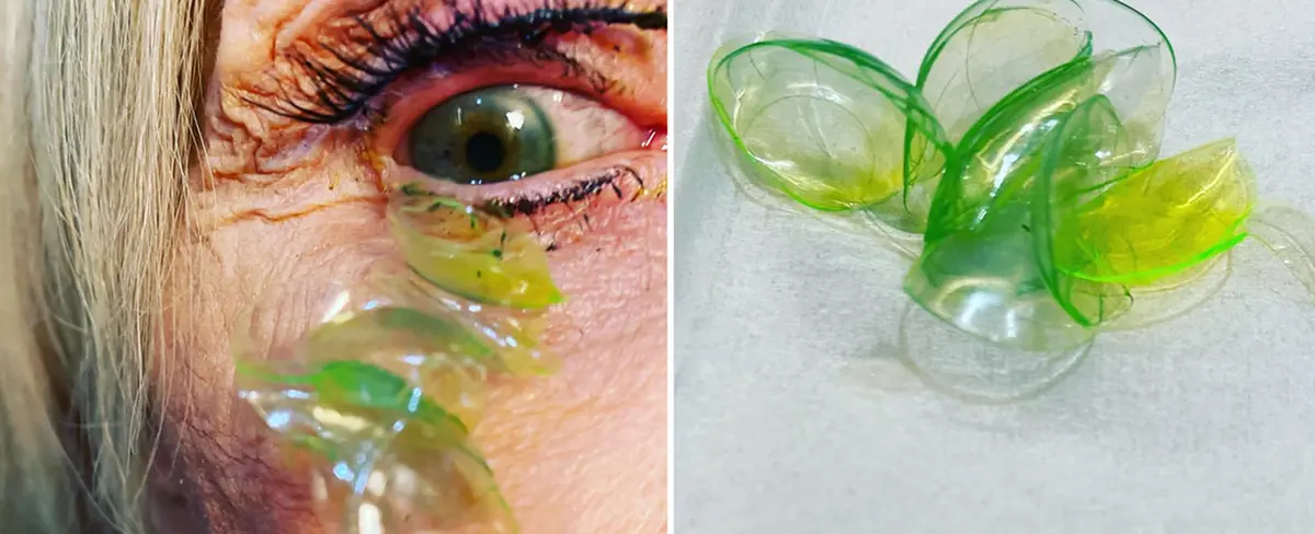 Oftalmóloga remueve 23 lentes  de contacto del ojo de una anciana