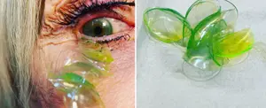 Oftalmóloga remueve 23 lentes  de contacto del ojo de una anciana