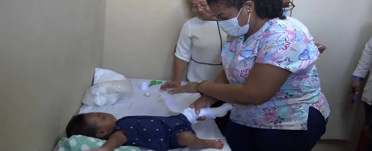 Inauguran sala para niños con pies equino varo en el Hospital de Bilwi