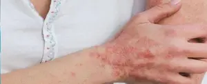 OMS: casos de mpox se redujeron un 90 % en últimos tres meses