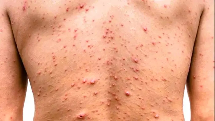 El Salvador en alerta por viruela símica pese a no registrar casos