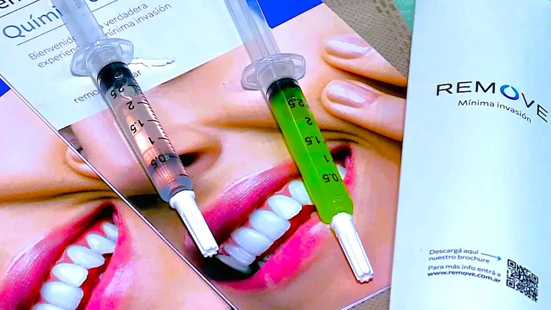 Nuevo avance dental elimina caries sin causar molestias