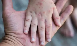 México registra 362 casos de sarampión y refuerza vacunación nacional